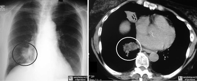 Lipoid Pneumonia